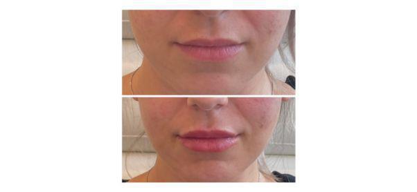 Lip Filler Before & After Image