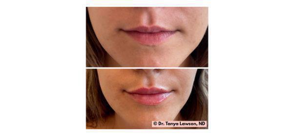 Lip Filler Before & After Image