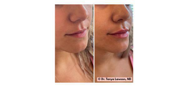 Lip Filler Before & After Image