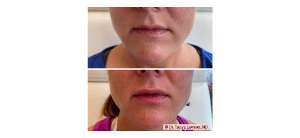 Lip Filler Before & After Image