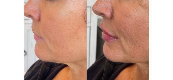 Lip Filler Before & After Image