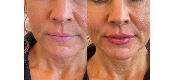 Lip Filler Before & After Image