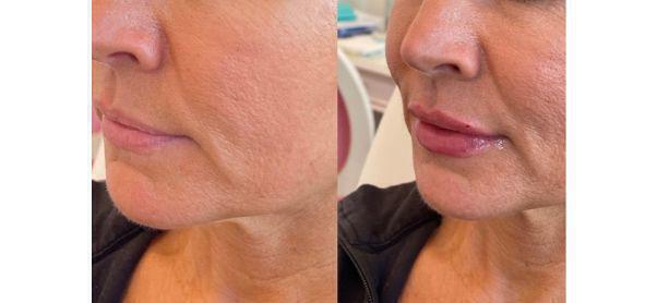 Lip Filler Before & After Image