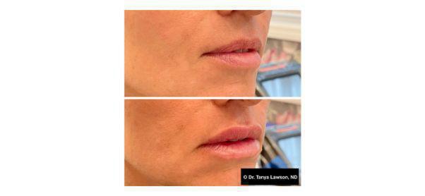 Lip Filler Before & After Image