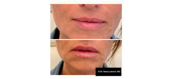 Lip Filler Before & After Image