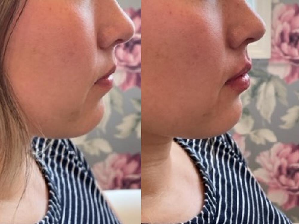 Lip Filler Before & After Image