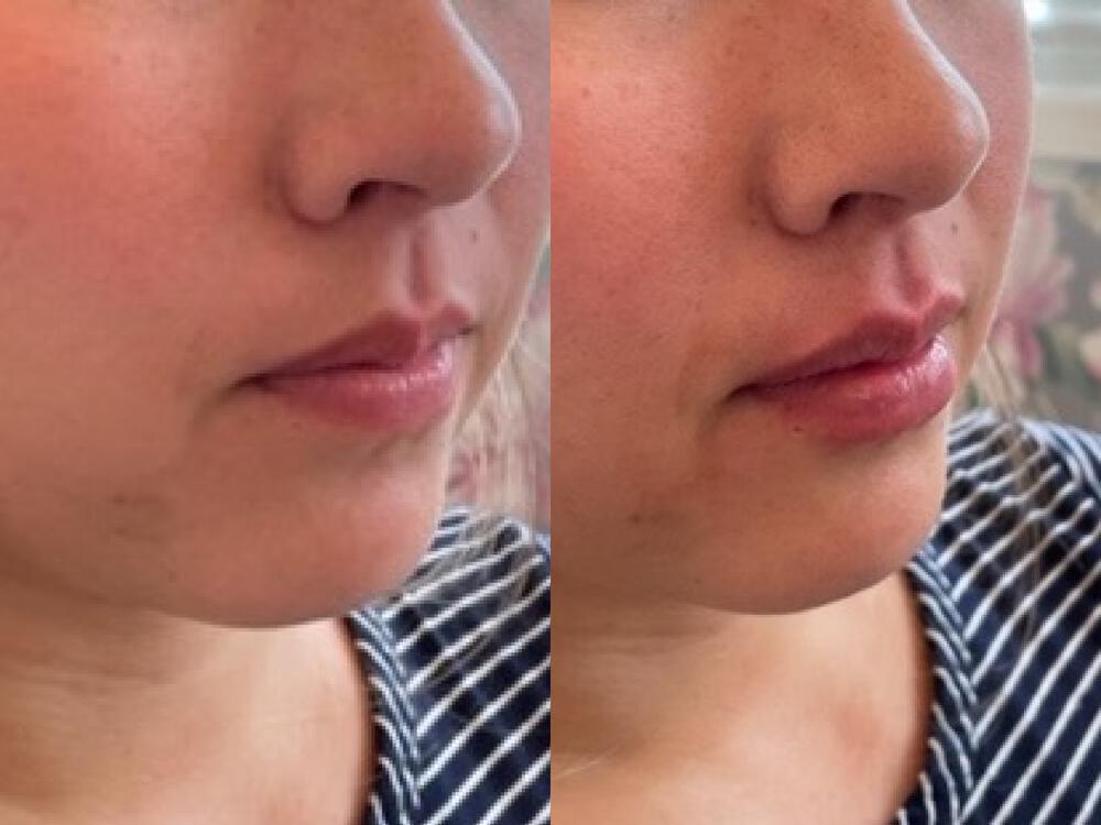 Lip Filler Before & After Image