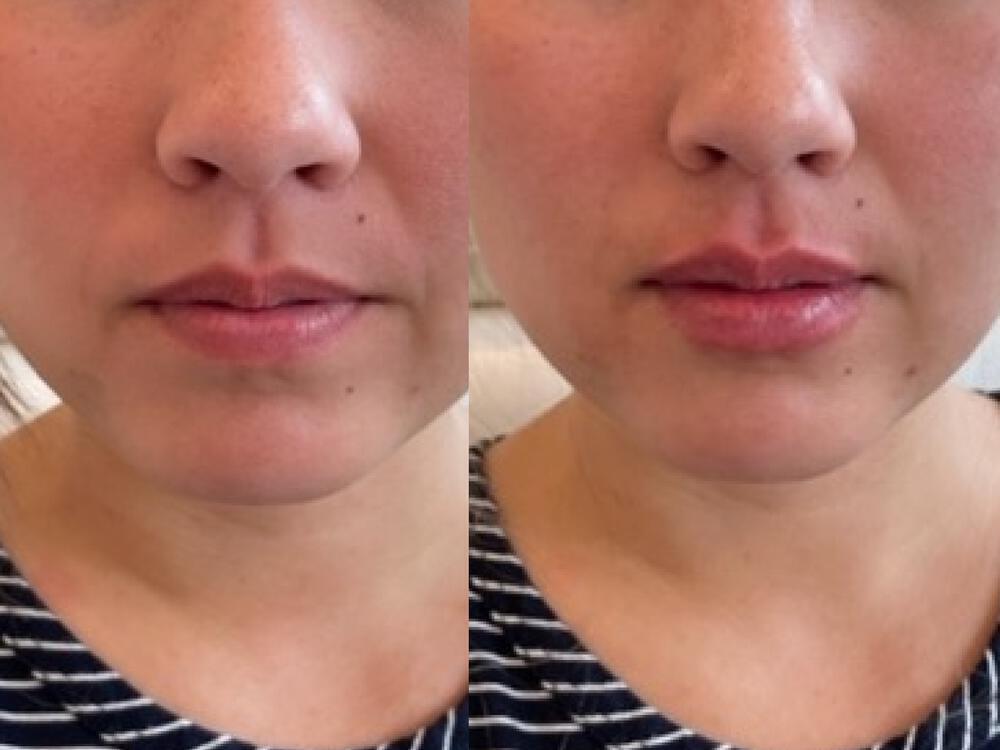 Lip Filler Before & After Image