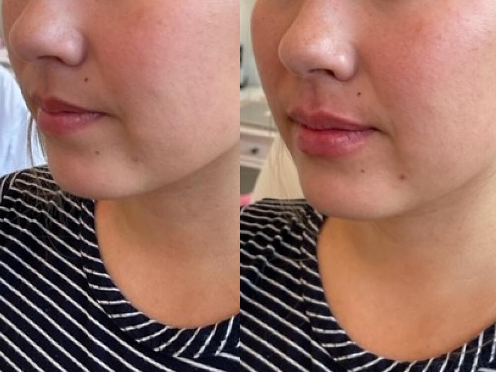 Lip Filler Before & After Image