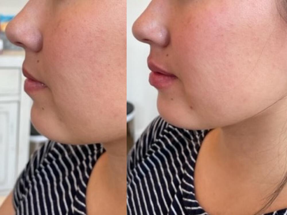 Lip Filler Before & After Image