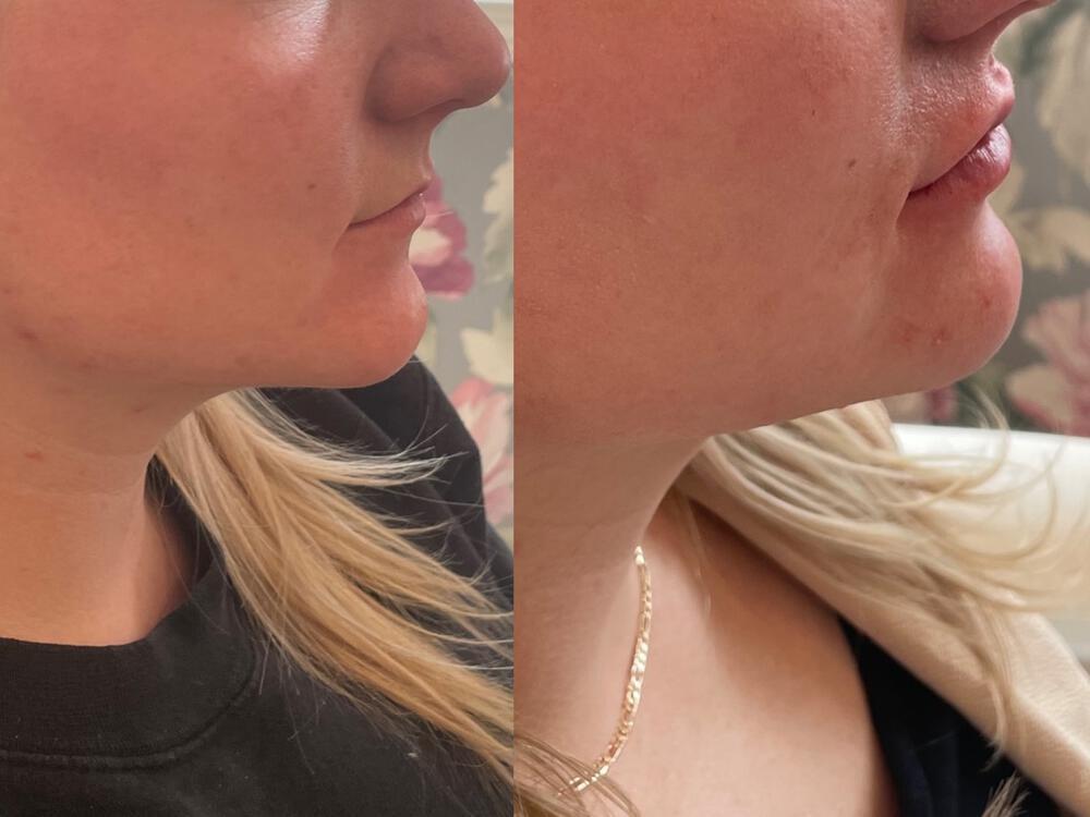 Lip Filler Before & After Image