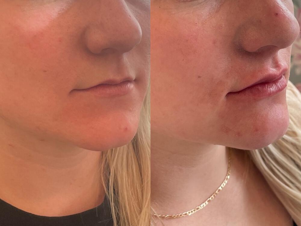 Lip Filler Before & After Image