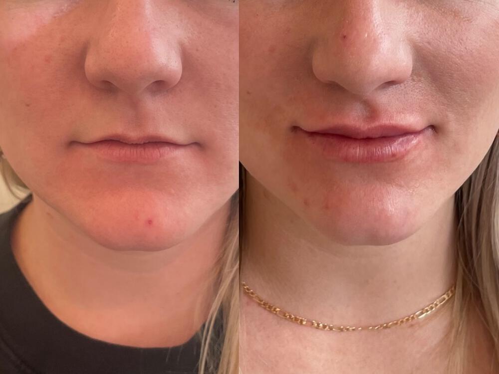 Lip Filler Before & After Image