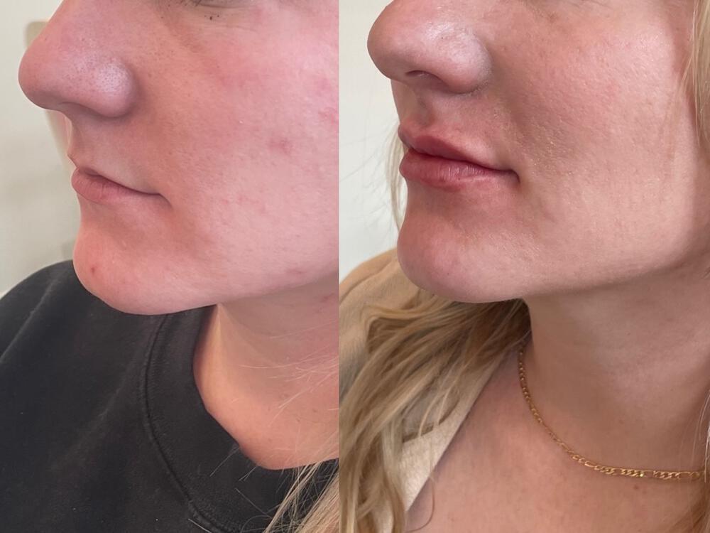 Lip Filler Before & After Image