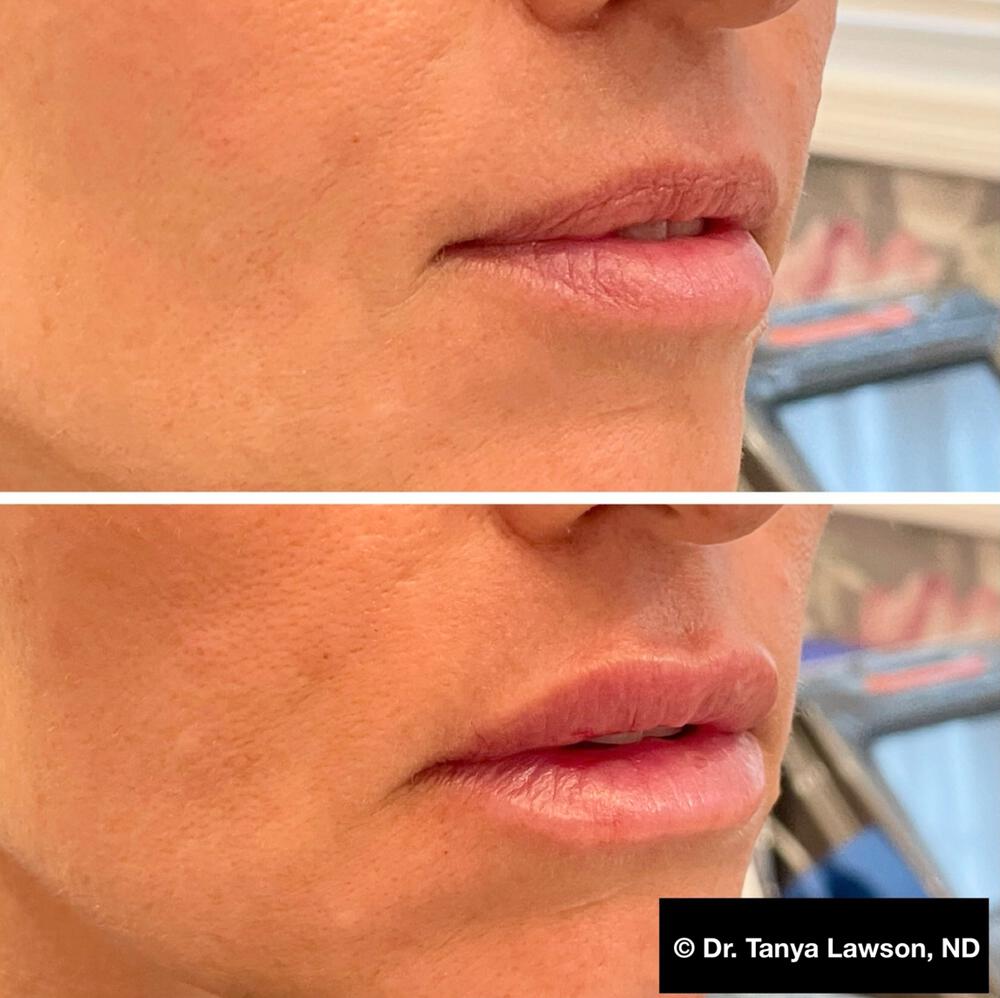 Lip Filler Before & After Image