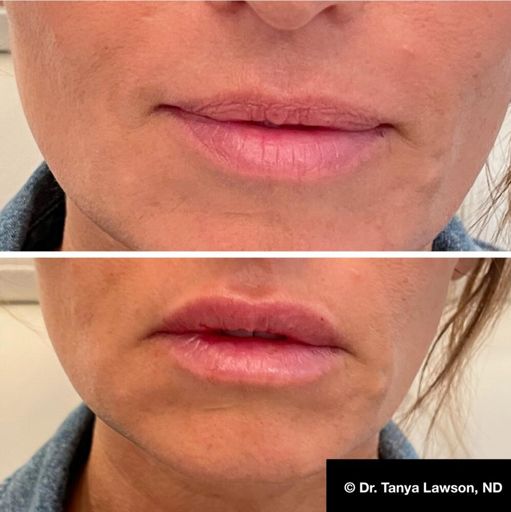 Lip Filler Before & After Image