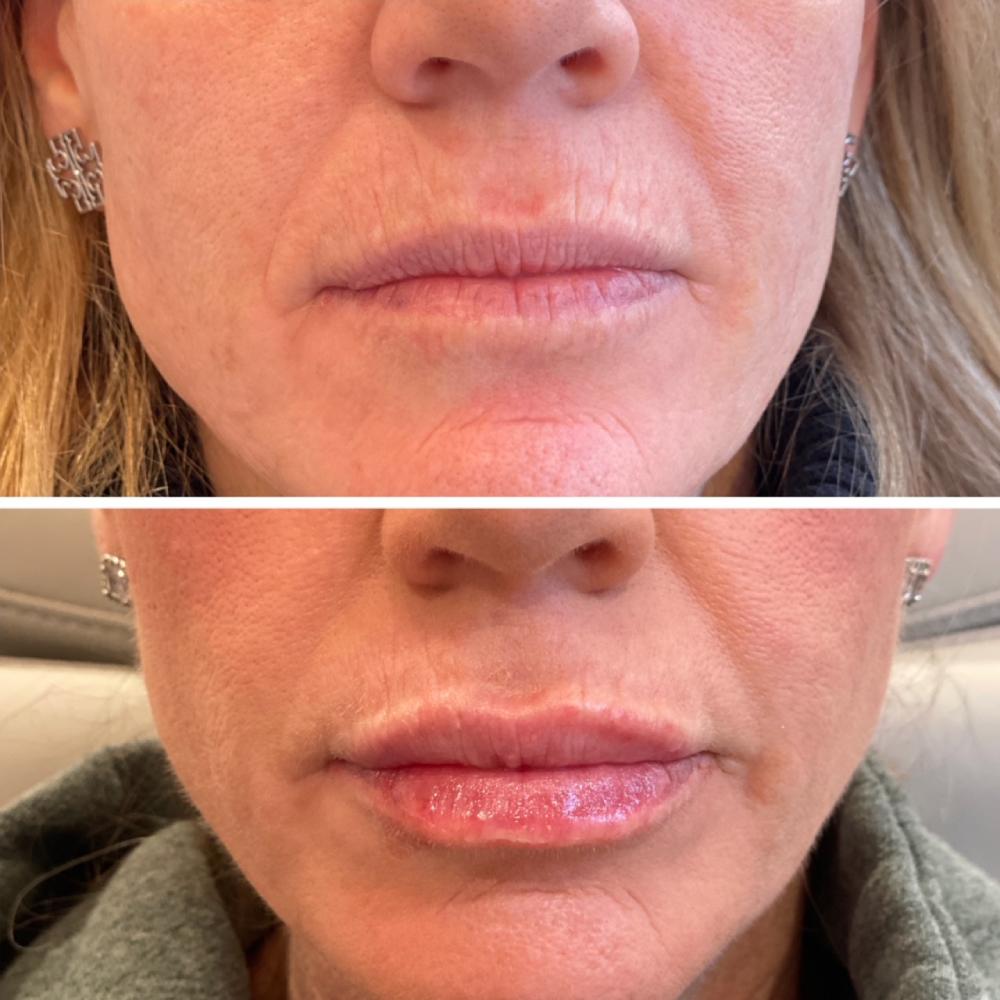 Lip Filler Before & After Image