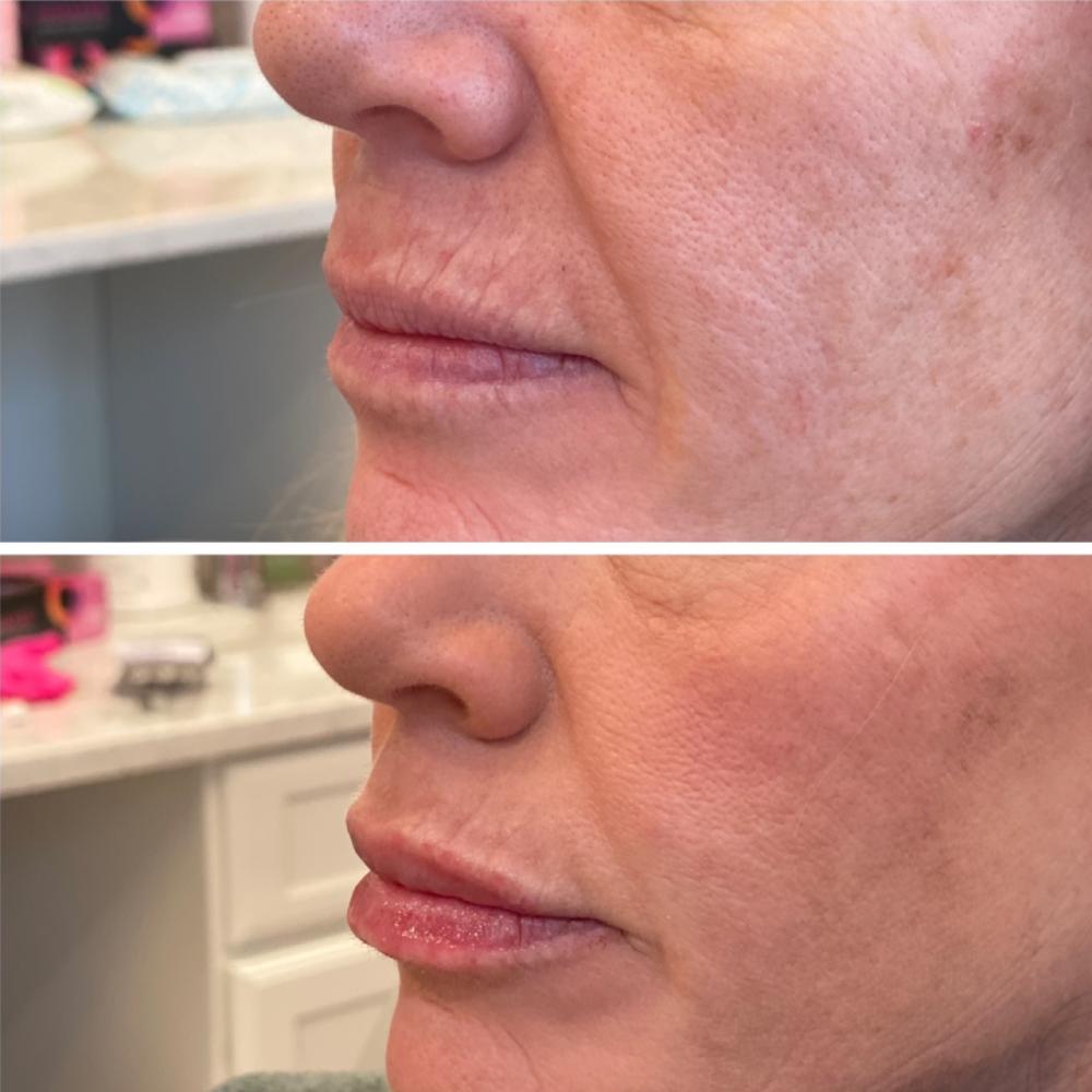 Lip Filler Before & After Image