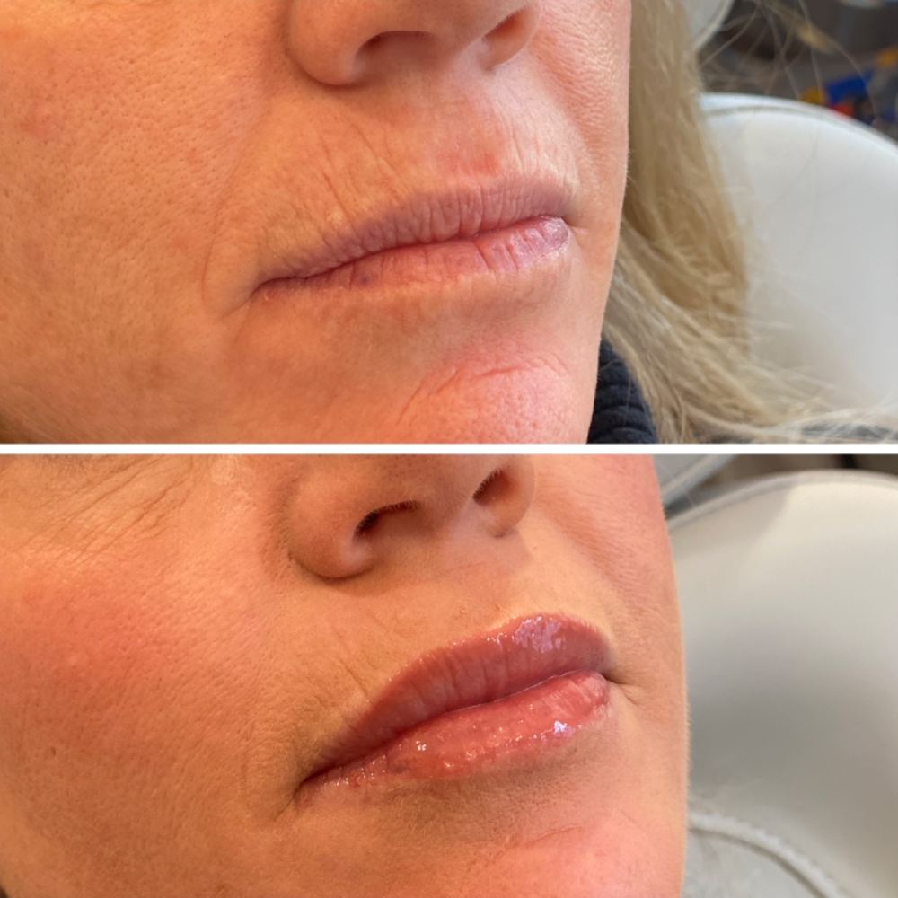 Lip Filler Before & After Image