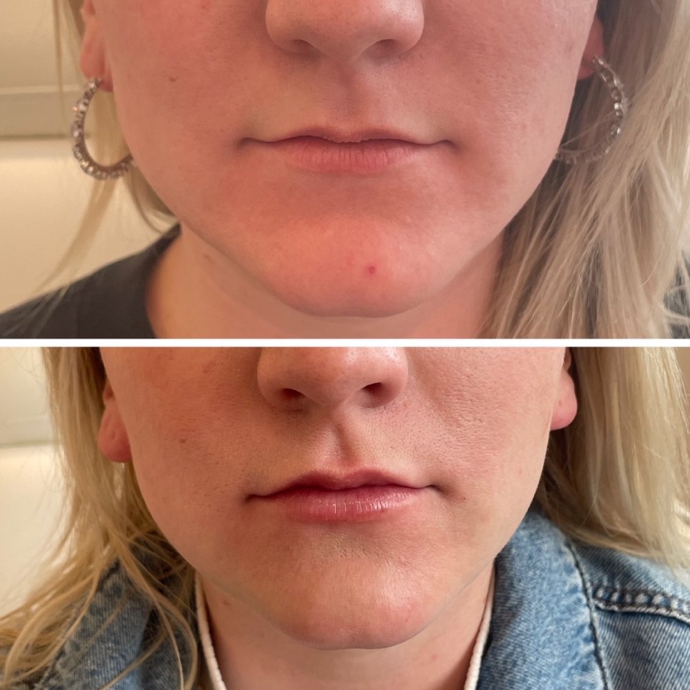 Lip Filler Before & After Image