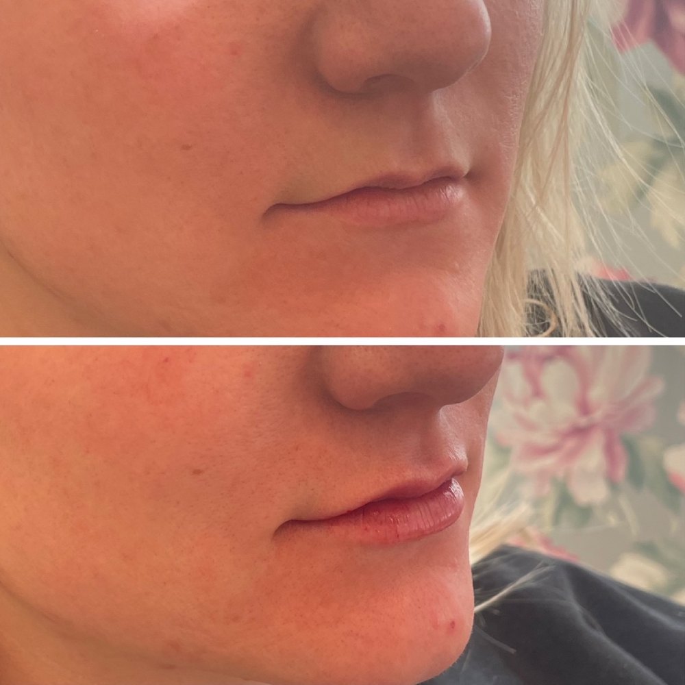 Lip Filler Before & After Image