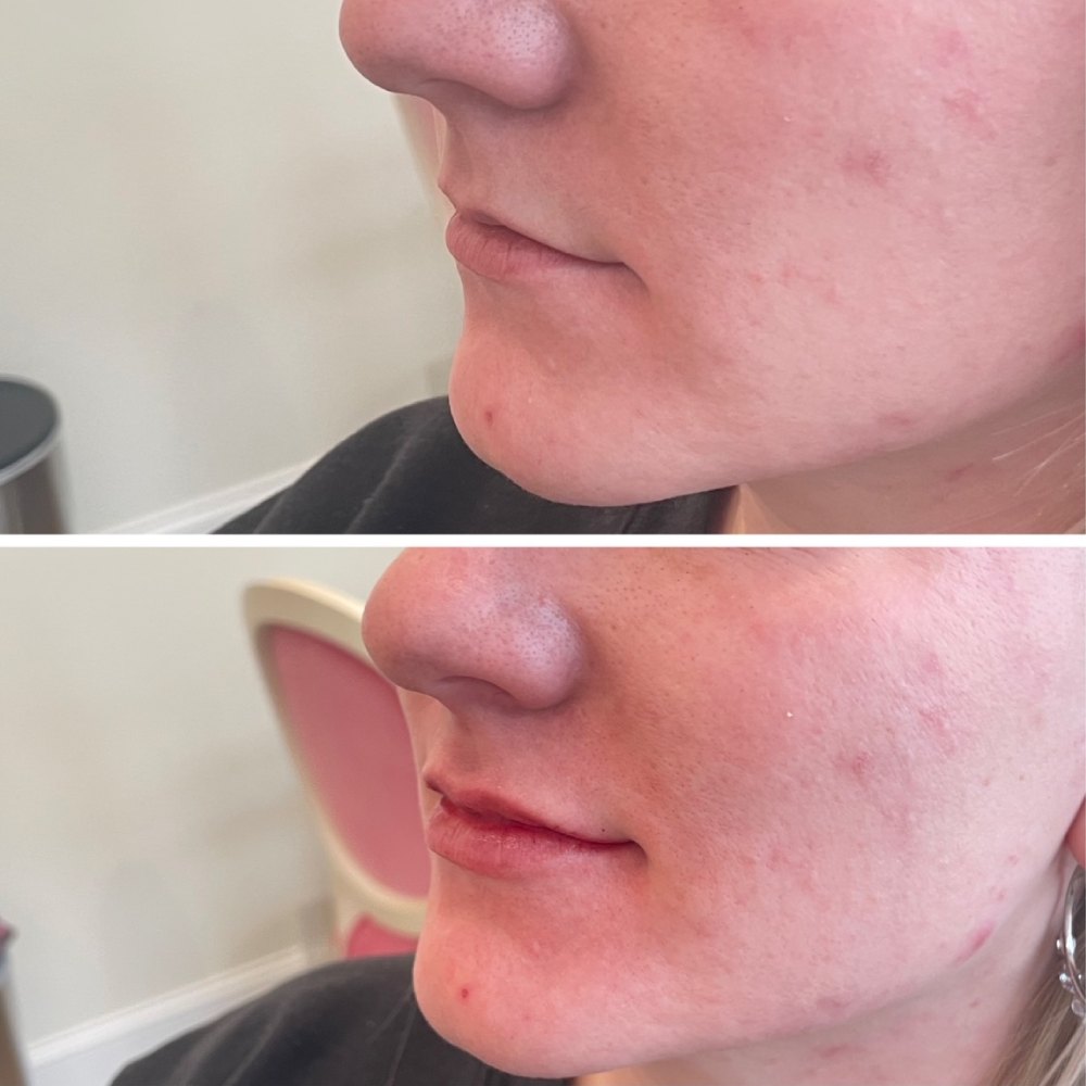 Lip Filler Before & After Image