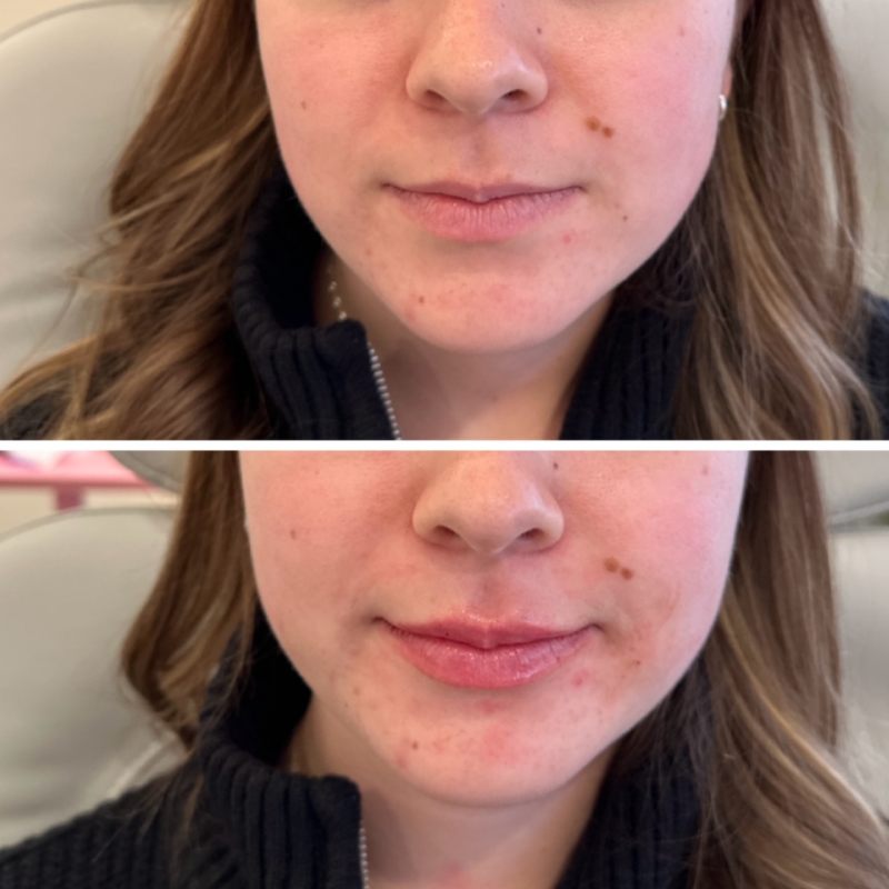 Lip Filler Before & After Image