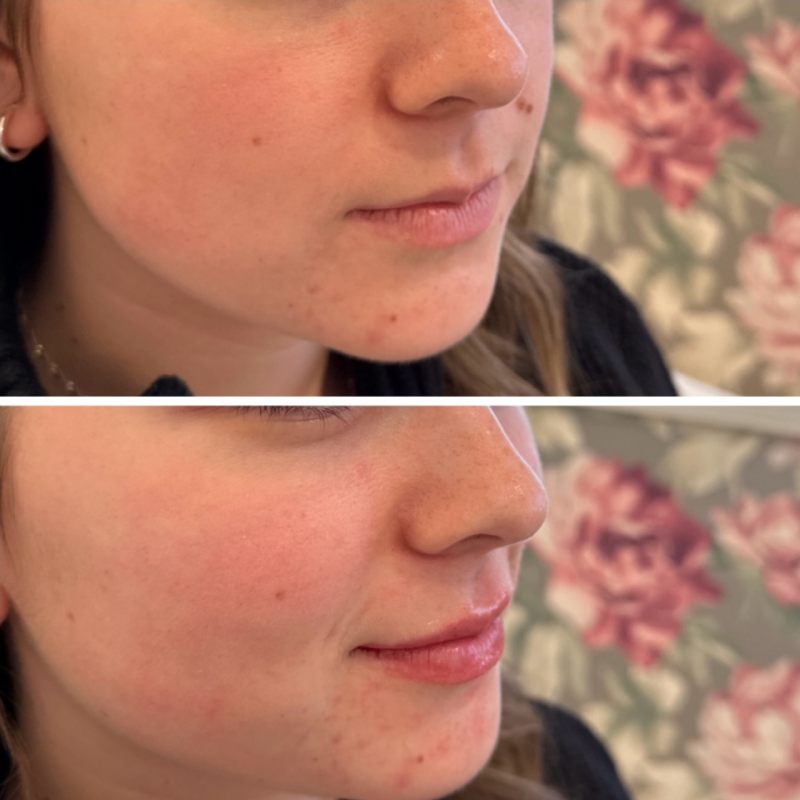 Lip Filler Before & After Image