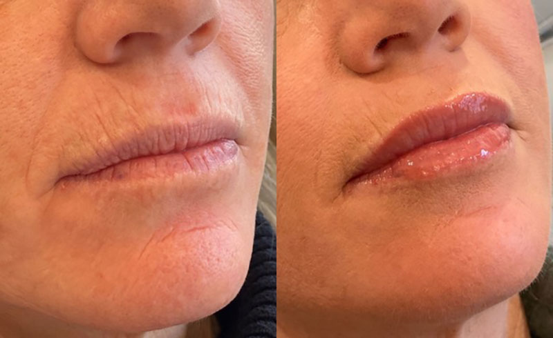 Lip Filler Before & After Image