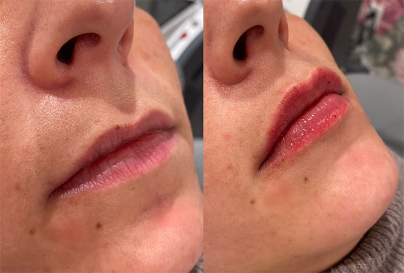 Lip Filler Before & After Image