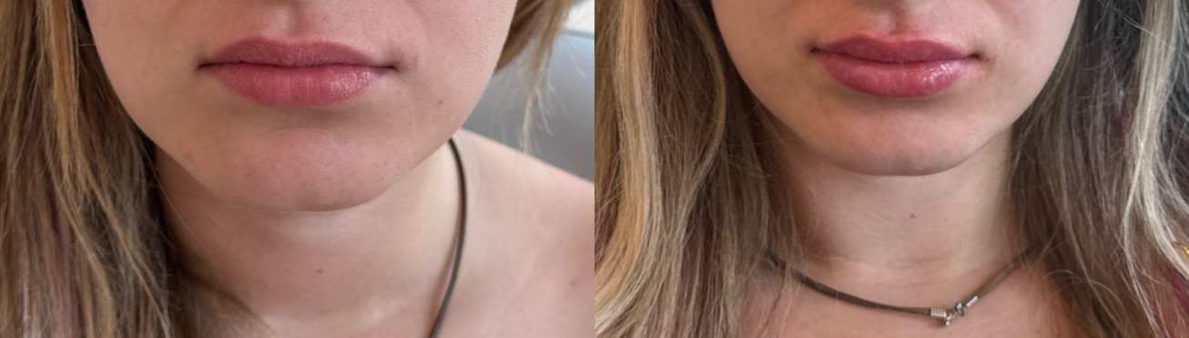 Lip Filler Before & After Image