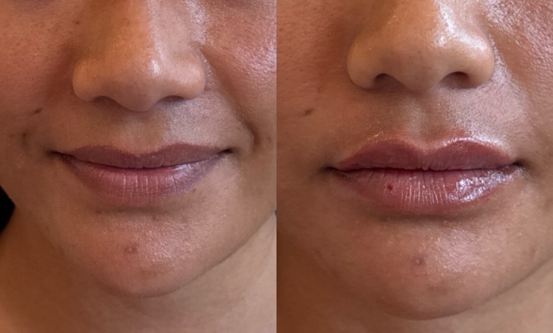 Lip Filler Before & After Image