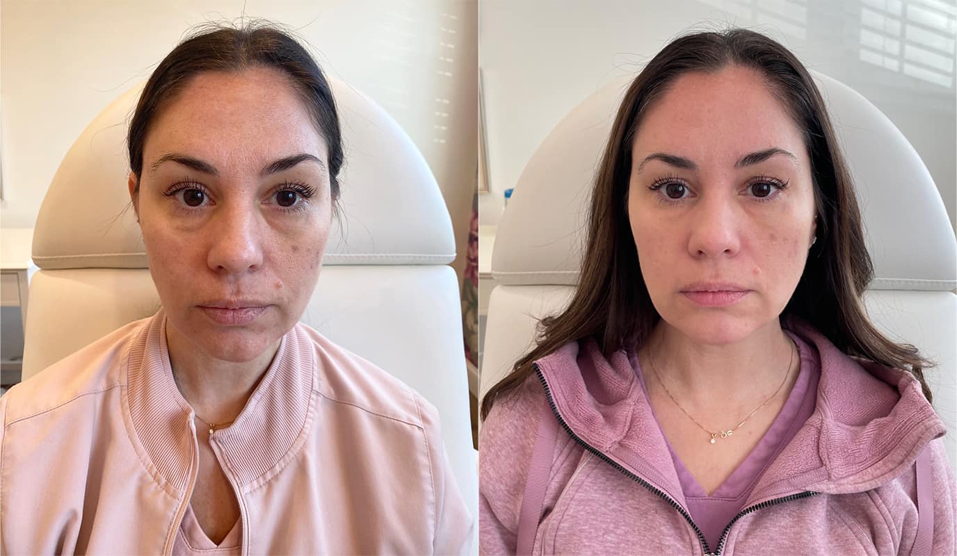 PRF Fillers Before & After Image