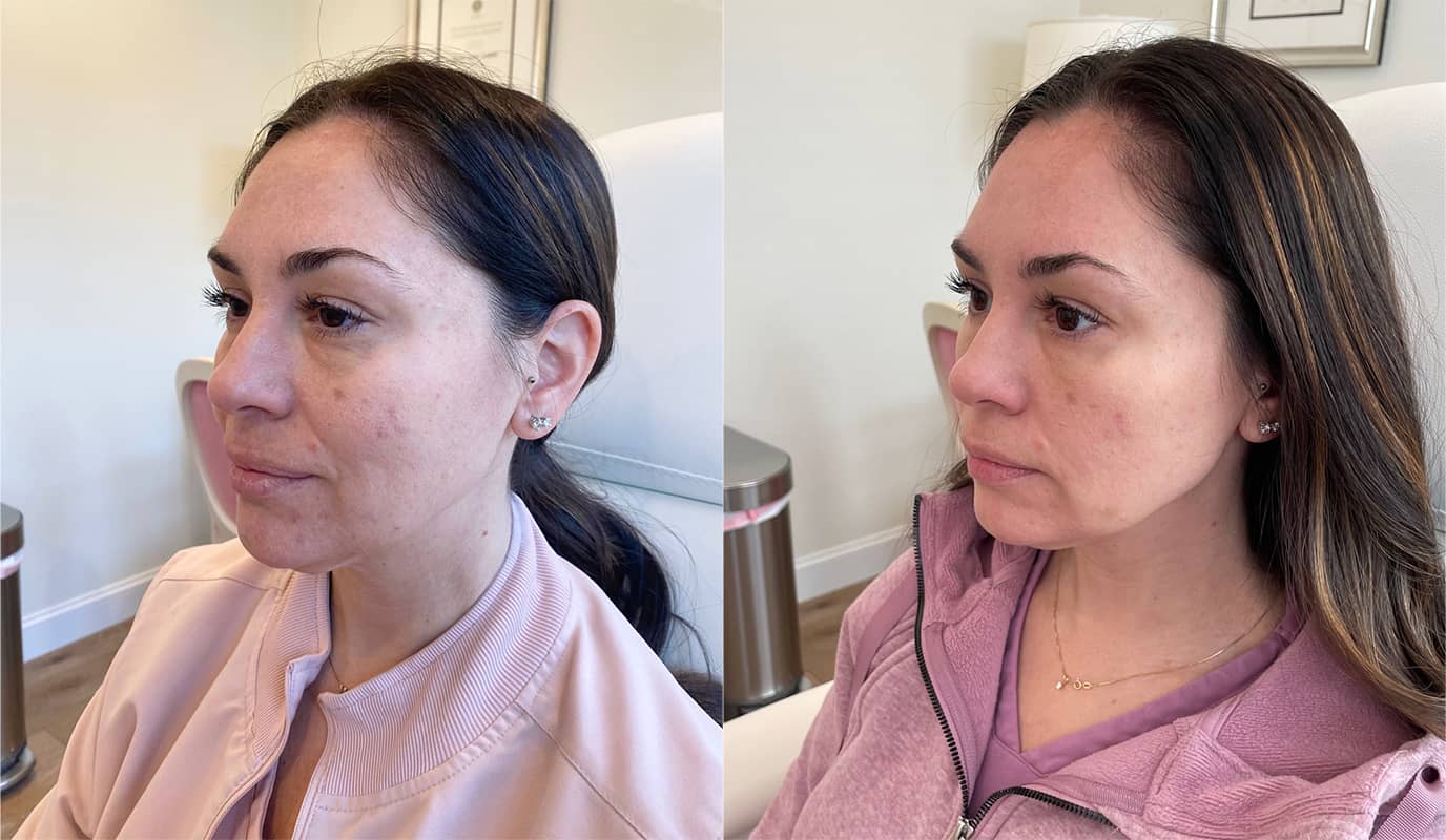 PRF Filler Before and After 01