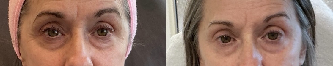 PRF Fillers Before & After Image