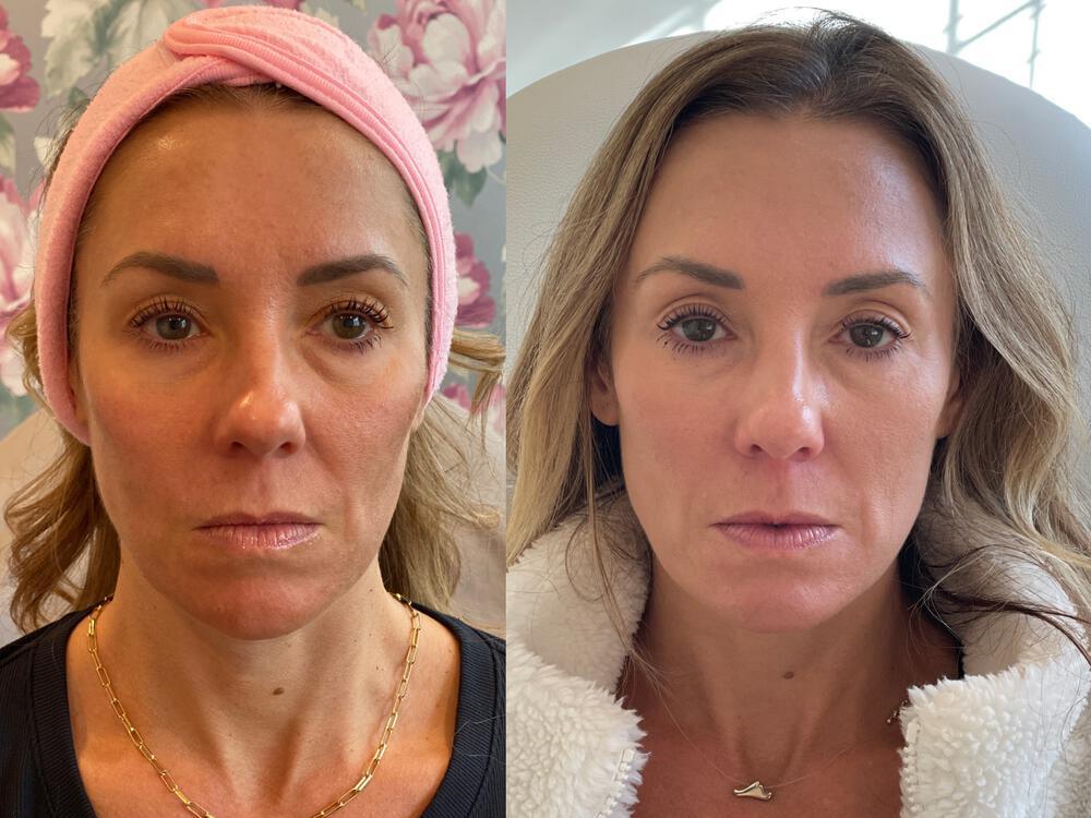 Sculptra Before & After Image