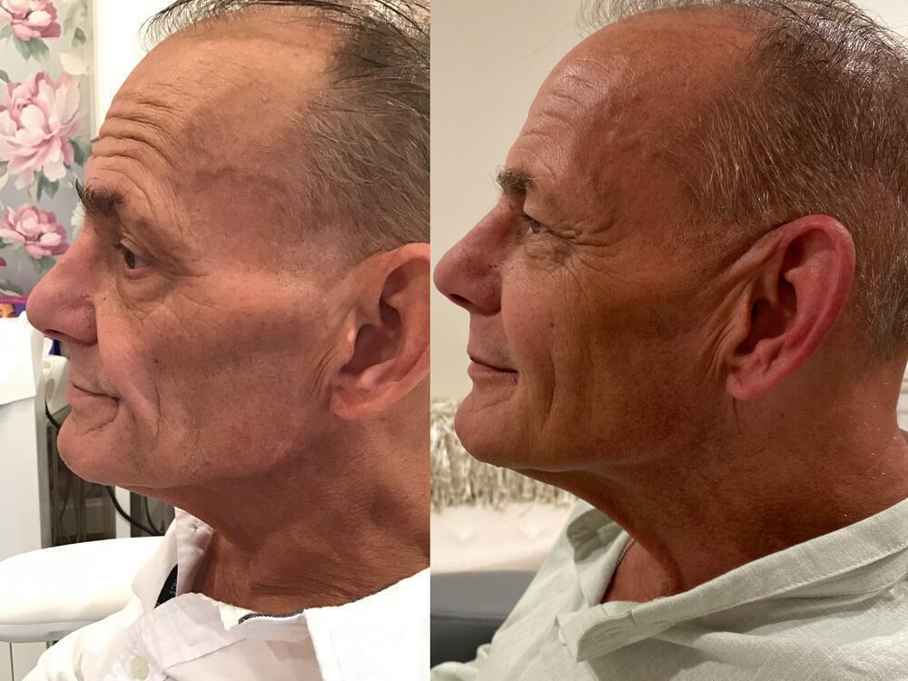 Sculptra Before & After Image