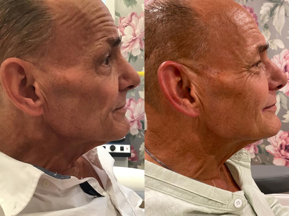 Sculptra Before & After Image