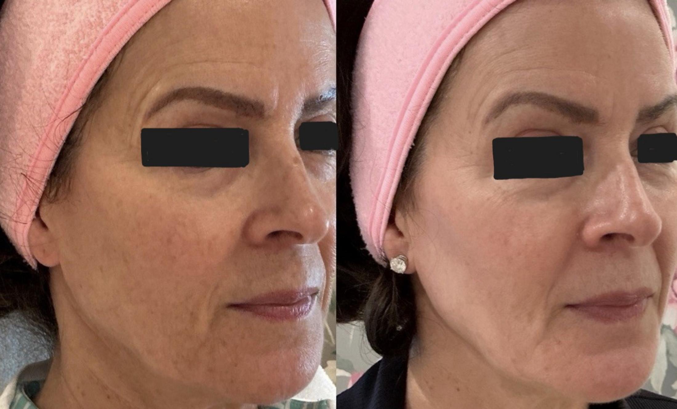 BBL HEROic Before & After Image