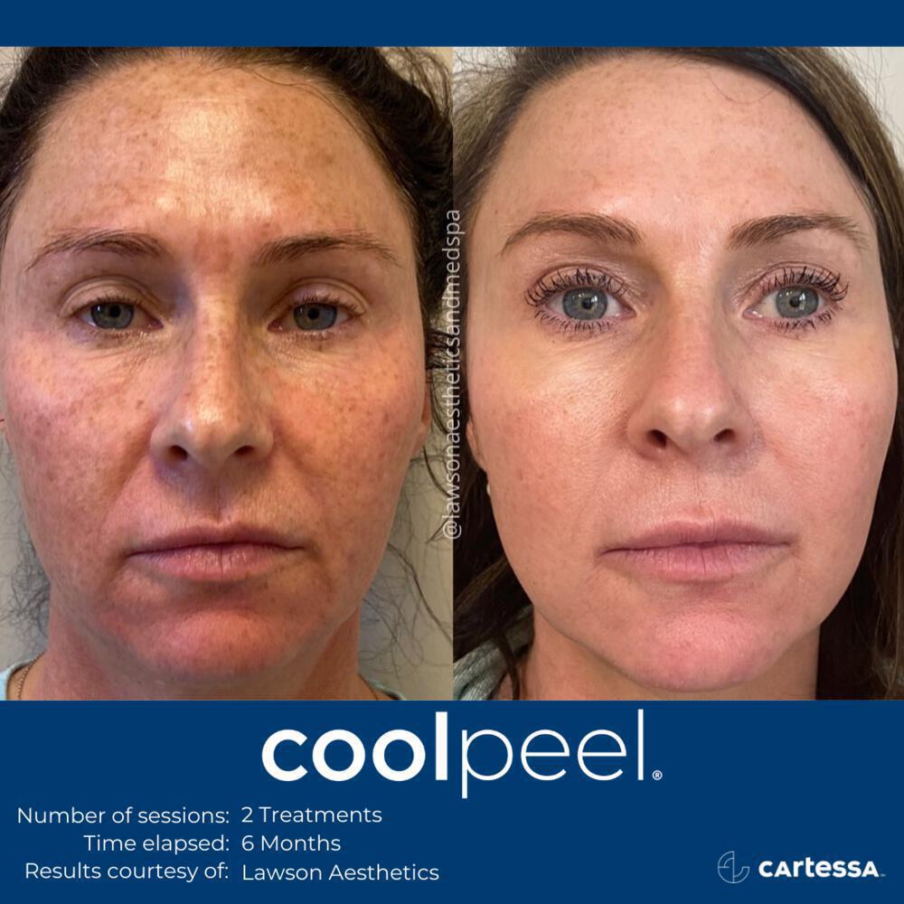 CoolPeel Before & After Image