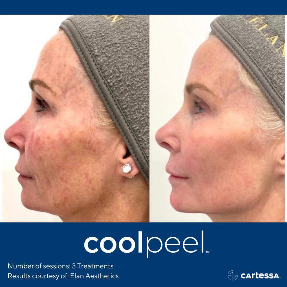 CoolPeel Before & After Image