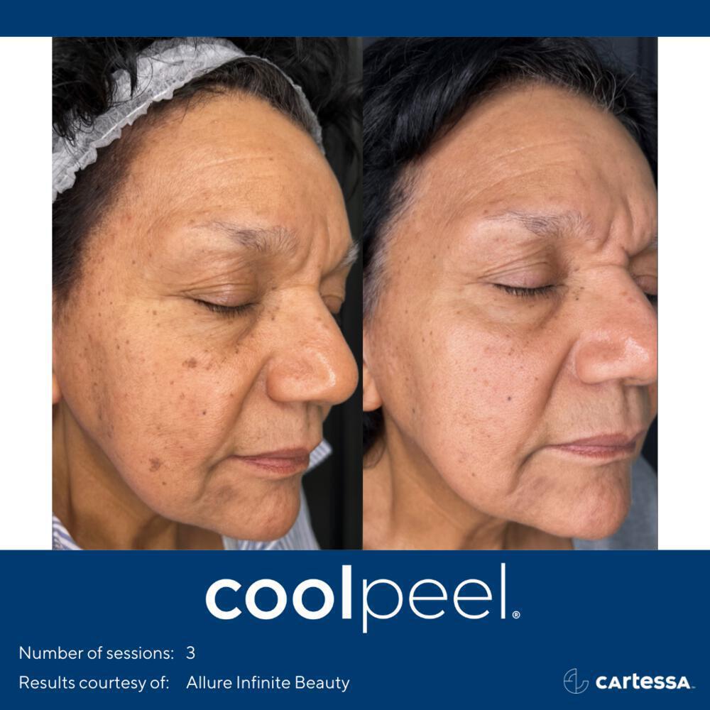 CoolPeel Before & After Image