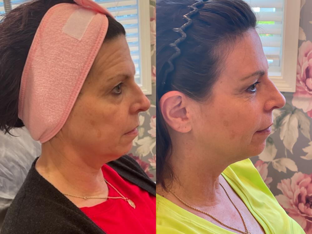 CoolPeel Before & After Image