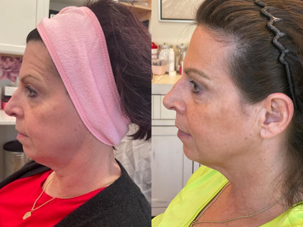 CoolPeel Before & After Image