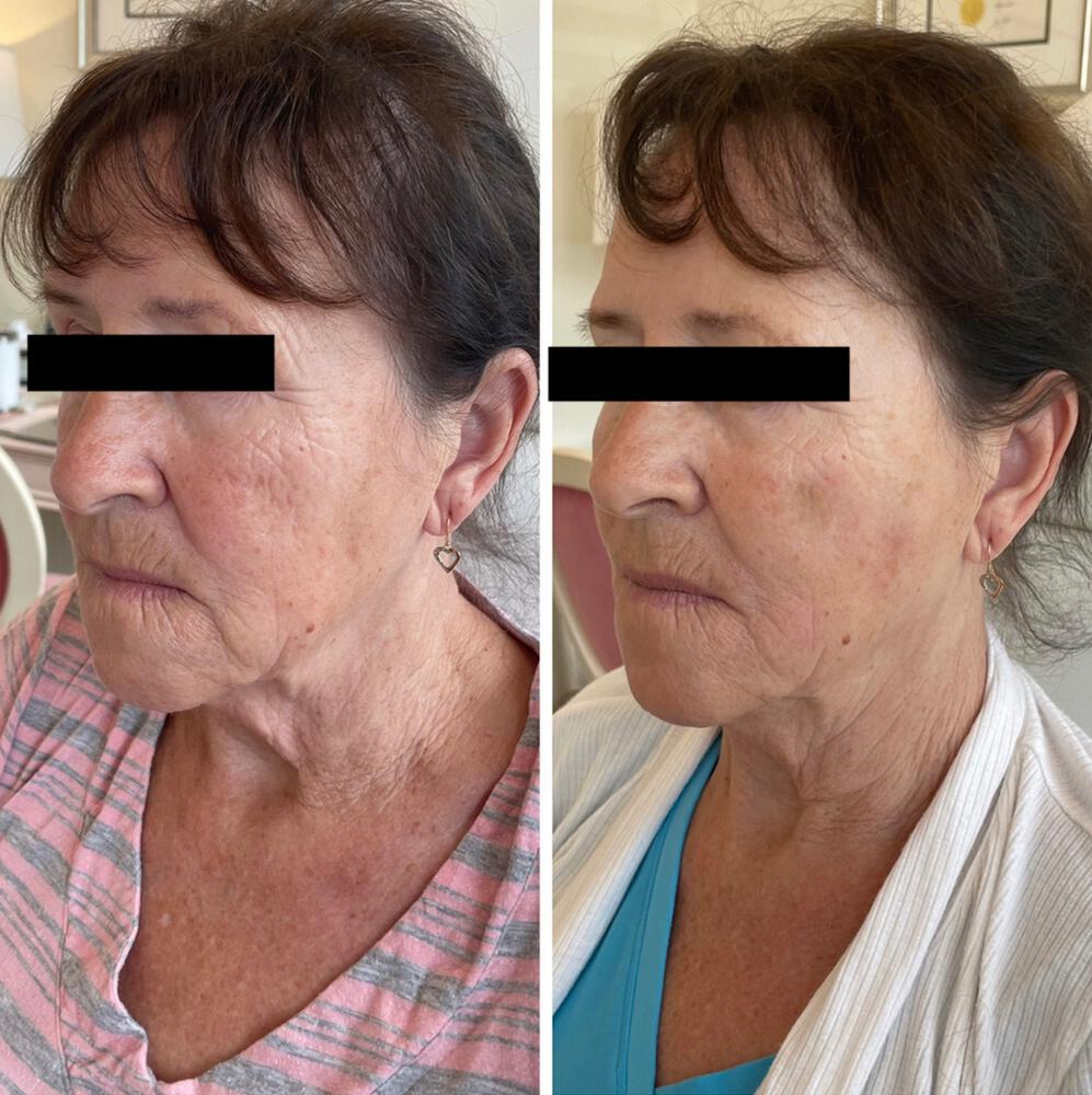 CoolPeel Before & After Image