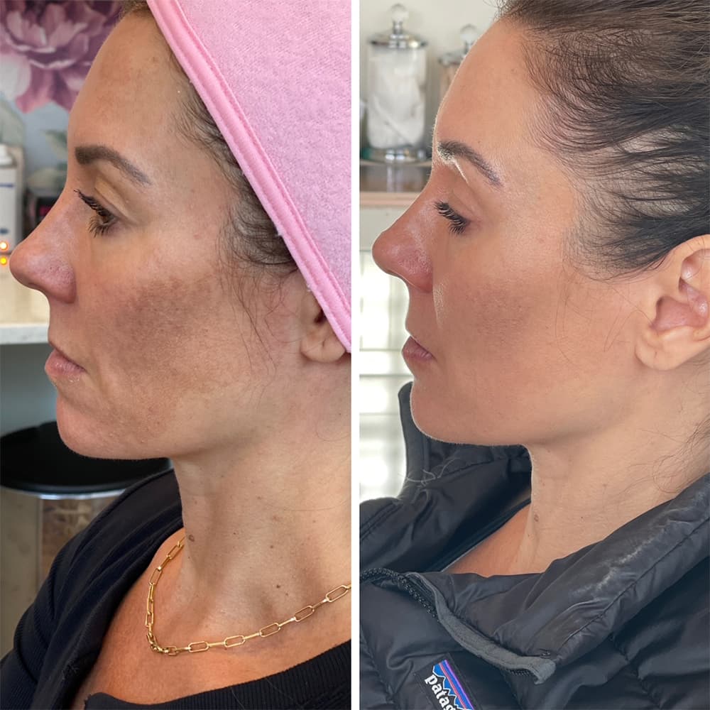 CoolPeel Before & After Image