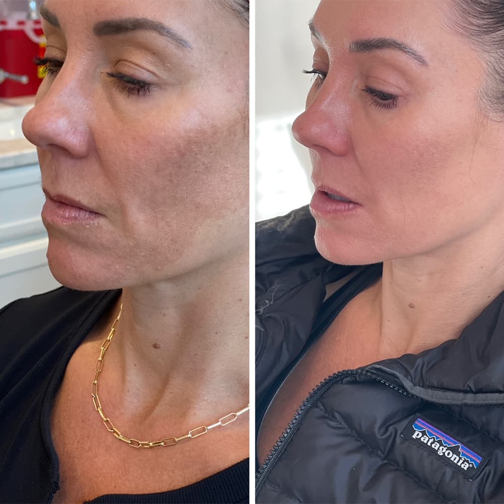 CoolPeel Before & After Image