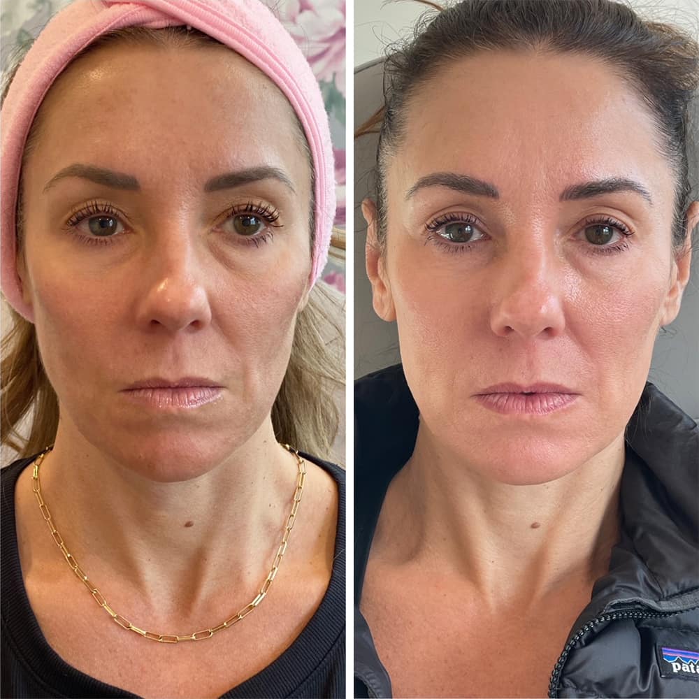 CoolPeel Before & After Image