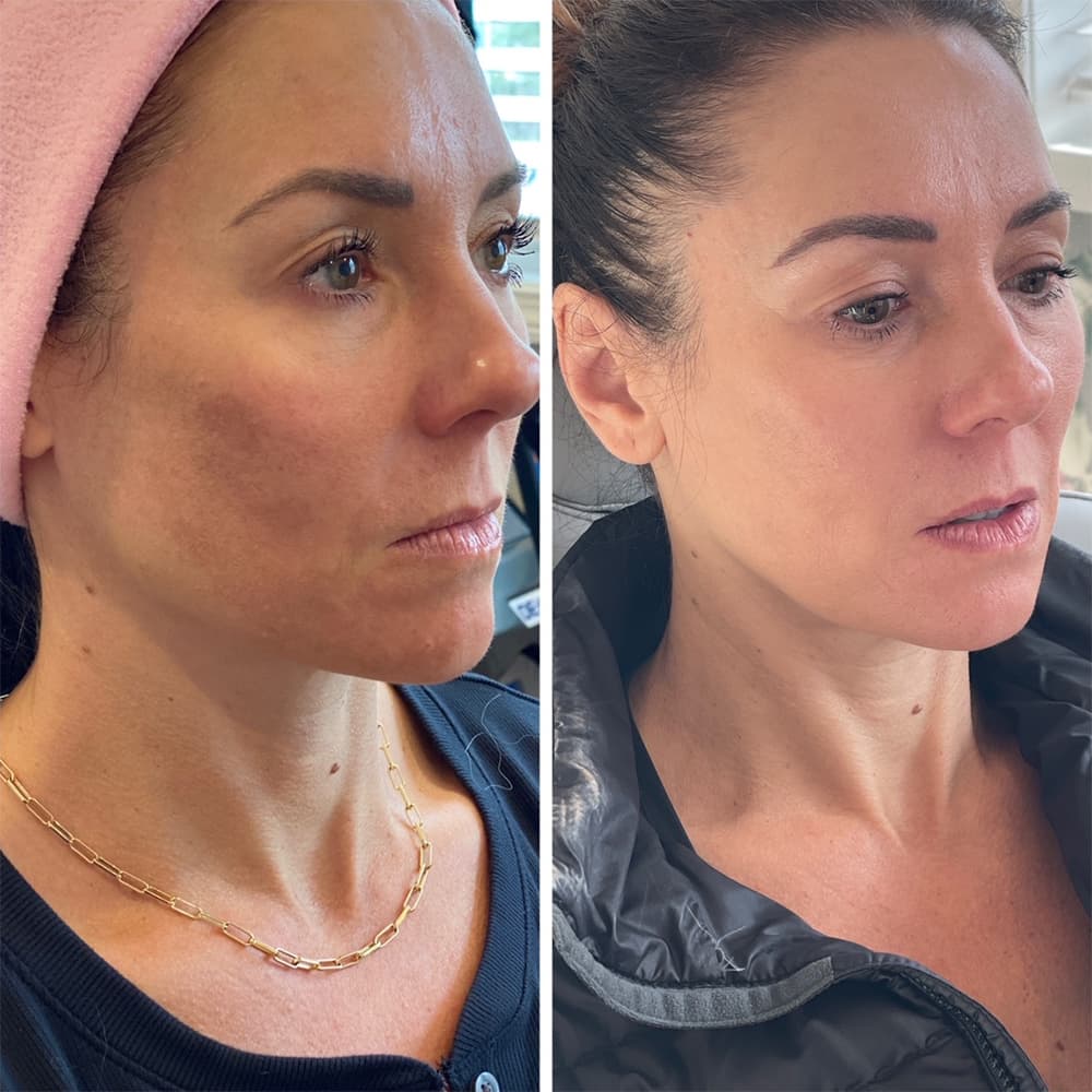 CoolPeel Before & After Image