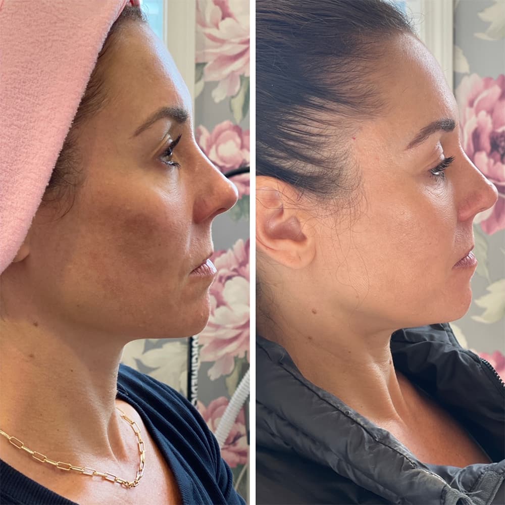 CoolPeel Before & After Image